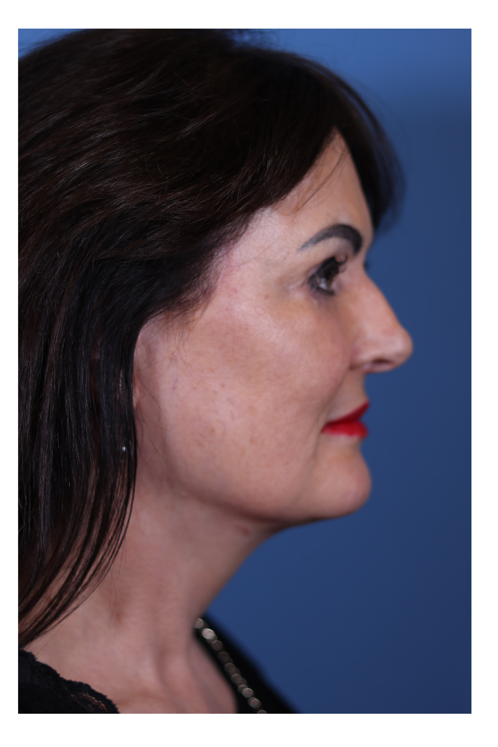 After - Patient 01 - Side View