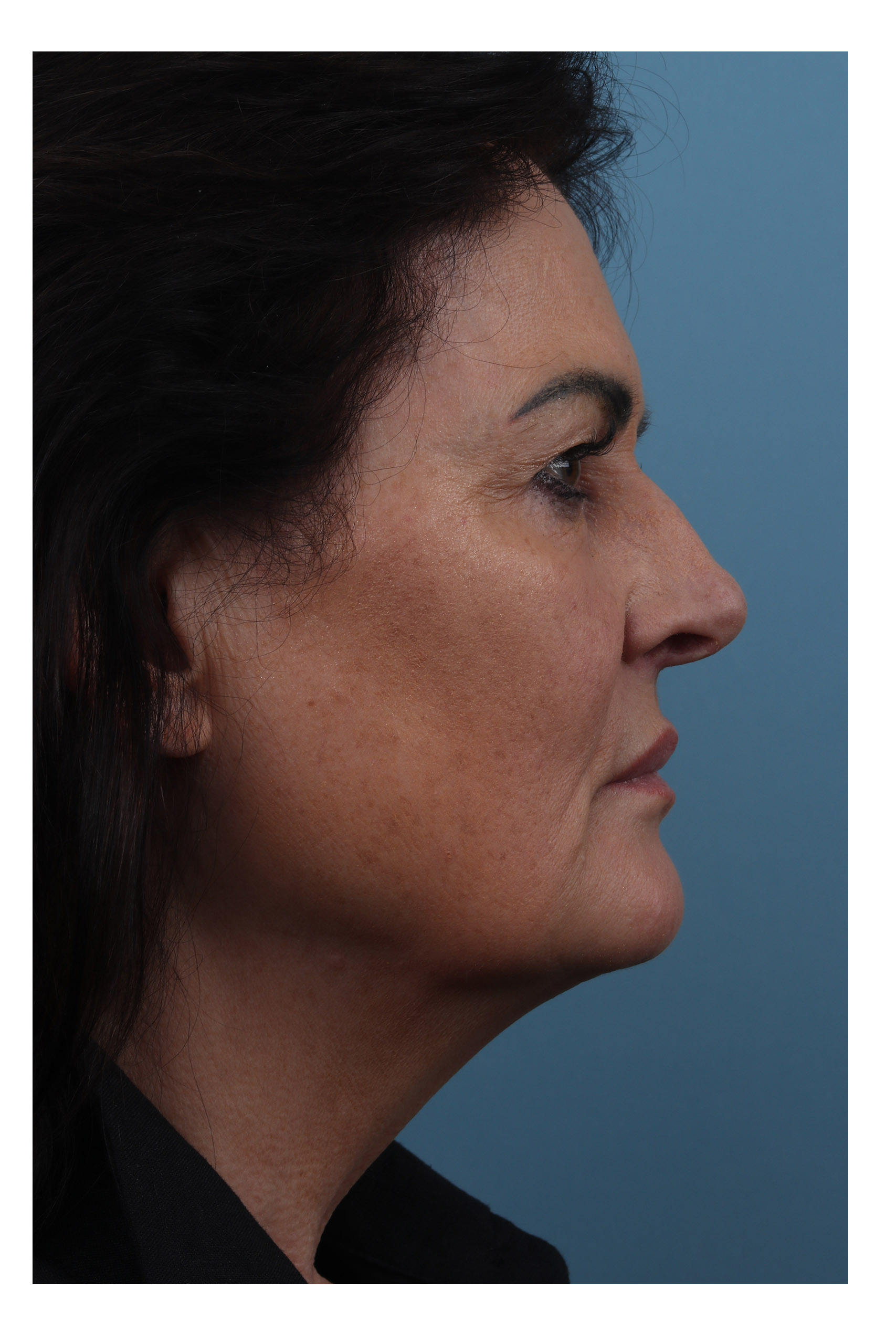 Before - Patient 01 - Side View
