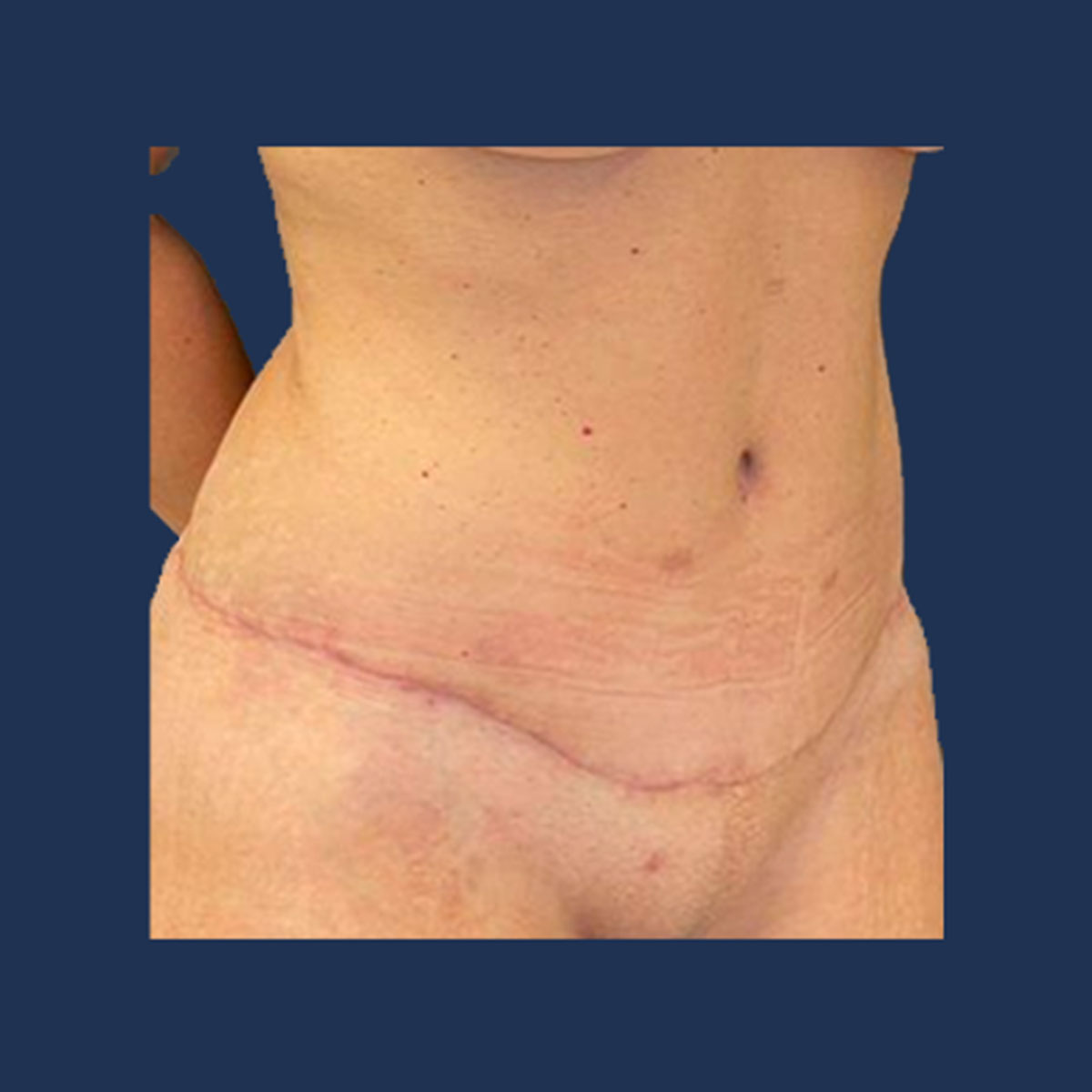 Patient 1 After Tummy Tuck