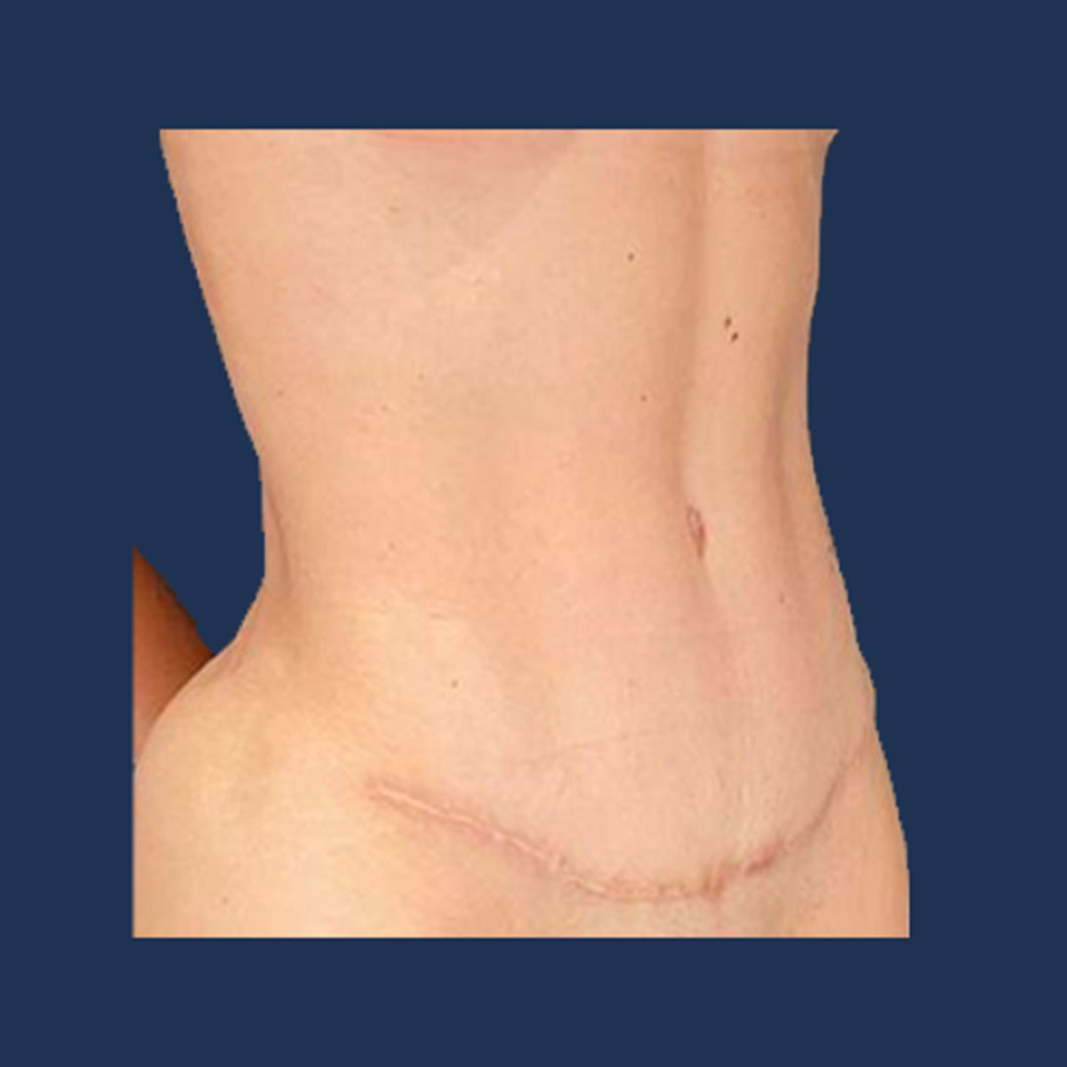 Patient 2 After Tummy Tuck