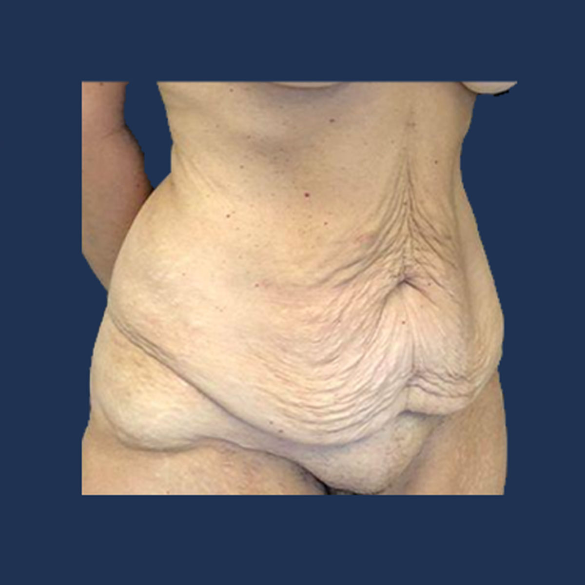 Patient 1 Before Tummy Tuck