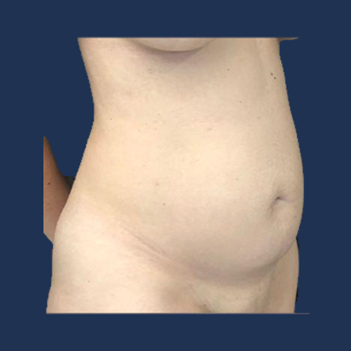 Patient 2 Before Tummy Tuck
