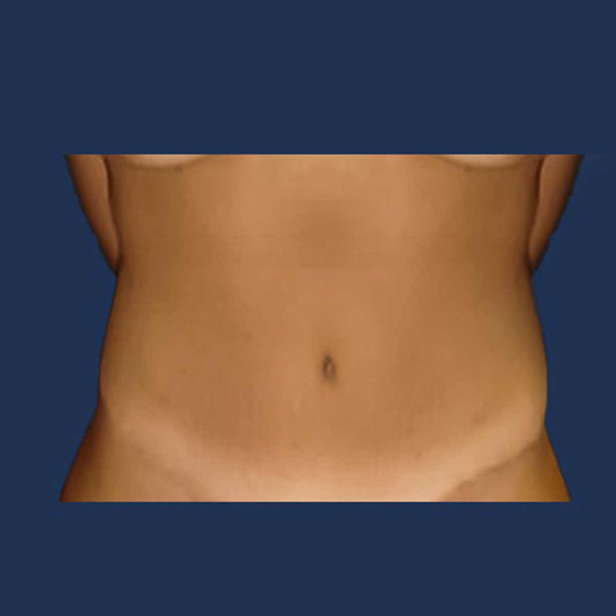 Patient 3 After Tummy Tuck