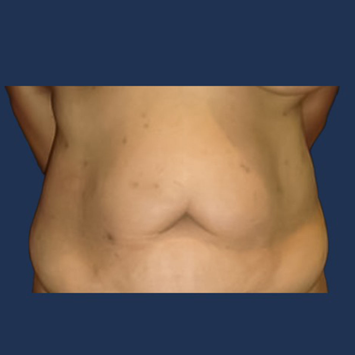 Patient 3 Before Tummy Tuck